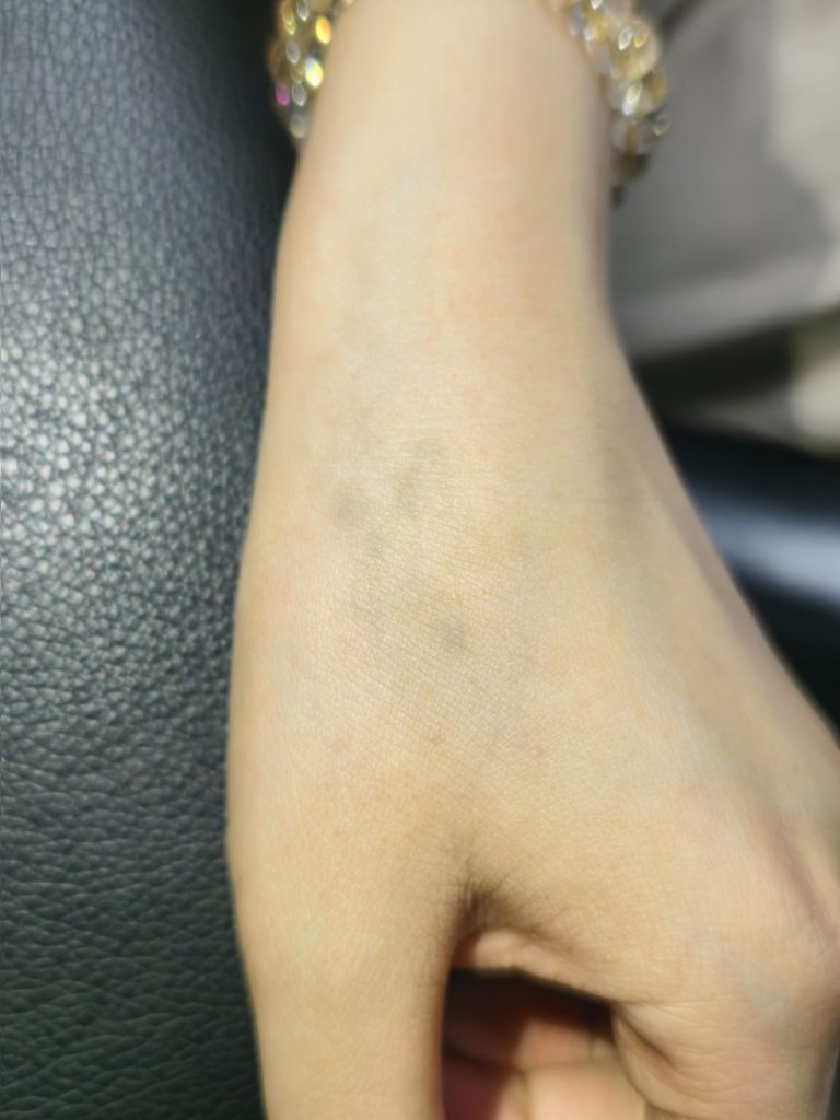 清洗4次后，术后图