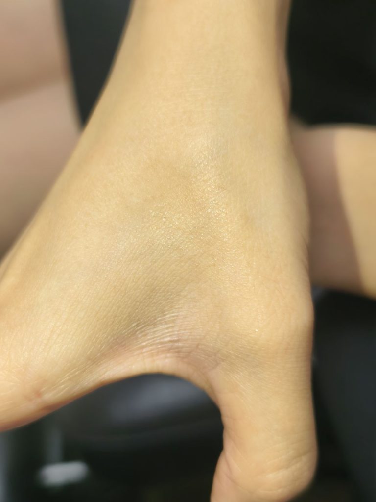 清洗4次后，术后图