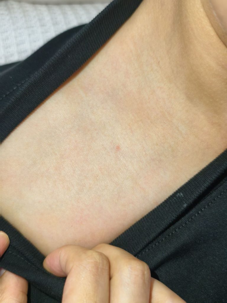 锁骨 · 清洗5次后，术后图