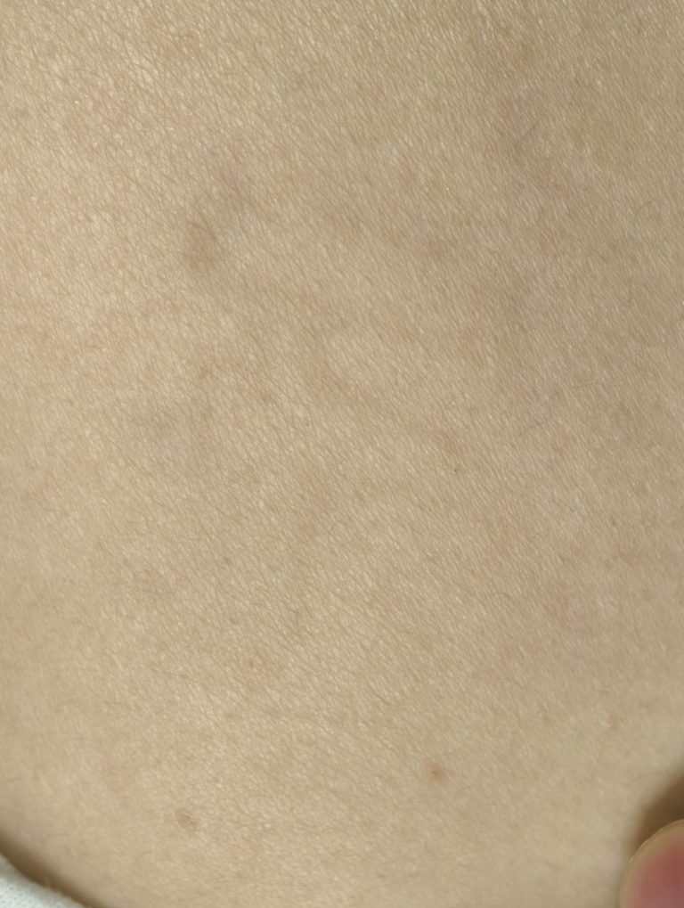锁骨 · 清洗2次后，术后图