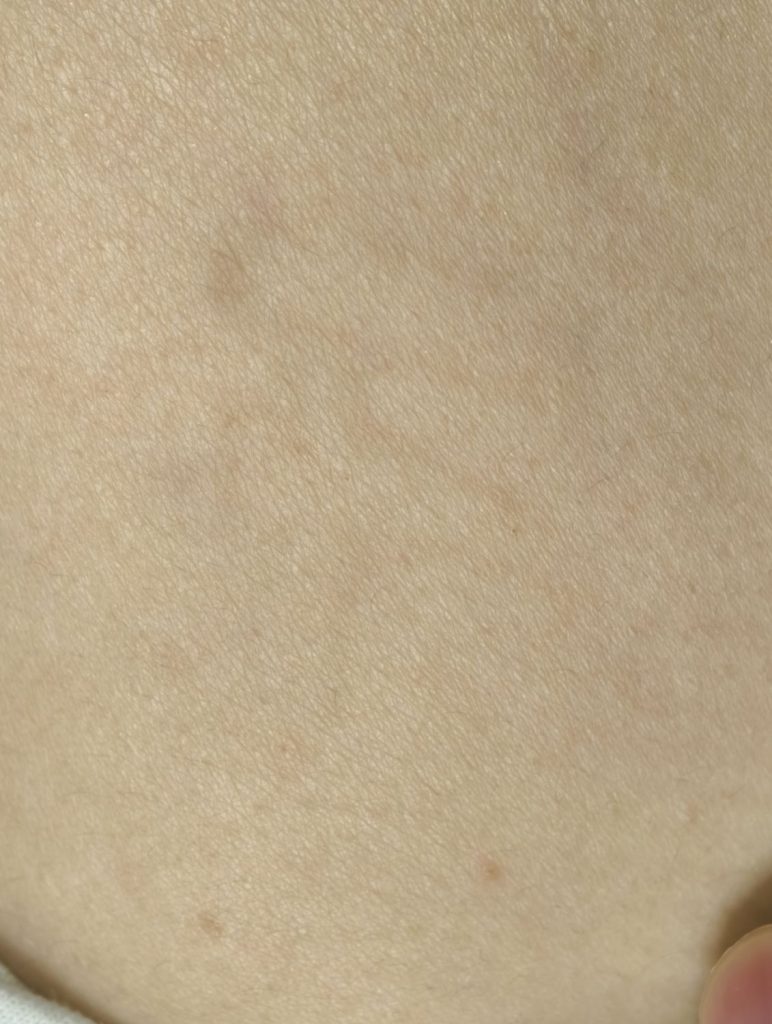 清洗2次后，术后图