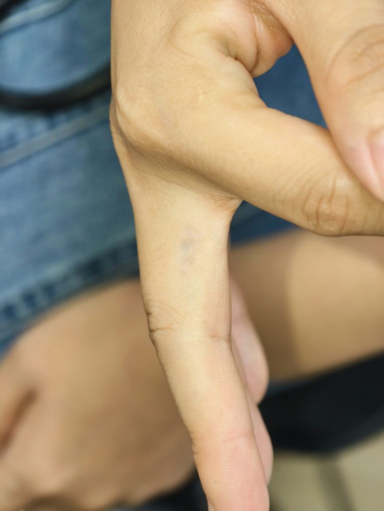手指4次后，术后图