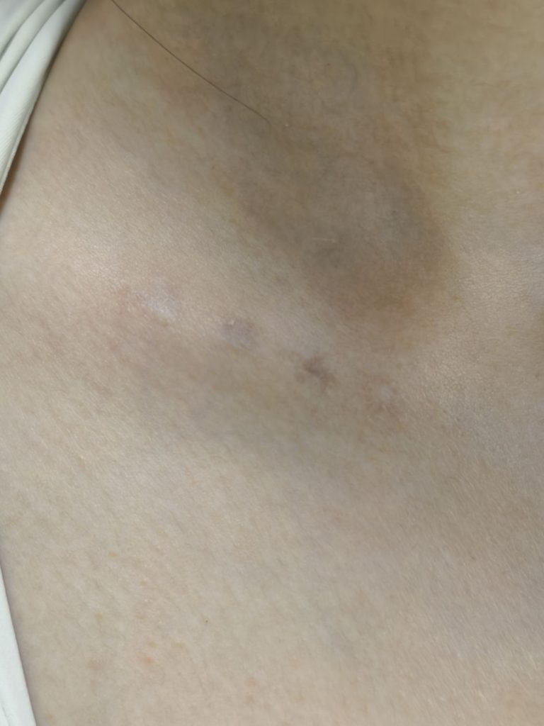 清洗4次后，术后图